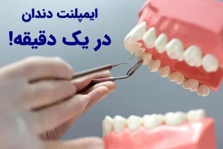ایمپلنت دندان دیجیتال بدون درد! بدون خونریزی! ضمانت مادام العمر