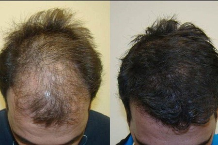 تغییرات فوق العاده ی اقای 36ساله در161روز، با یک روش گیاهی