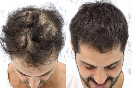 وقته تغییره🔥 با اختراع پزشک یزدی کاشت مو کنسله😉 (درمان ریزش مو)